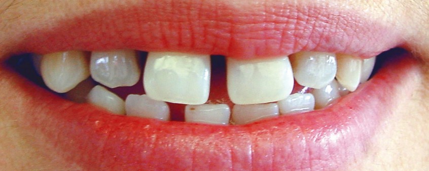 Natürliche Zähne - Thumfart's Zahntechnik GmbH